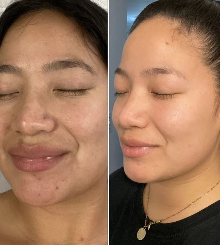 Sébum Contrôle + Sérum : votre solution parfaite contre les visages huileux et l'excès de sébum